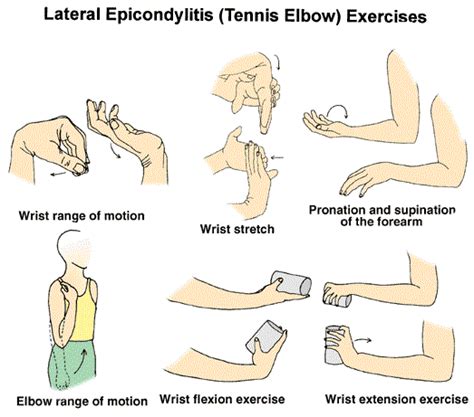 Lateral Epicondylitis, a.k.a. “Tennis Elbow” | Austin Sports Therapy