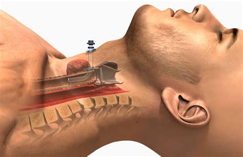 Tracheostomy: Uses, Procedure, Side Effects, and Results