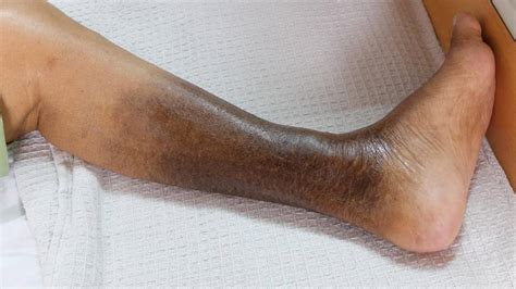 Leg Discoloration | Imaging And Interventional Specialists