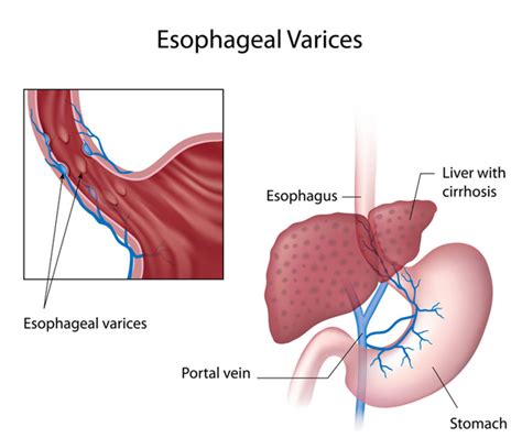 Bleeding Esophageal Varices – Official Website