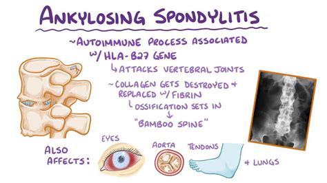 Ankylosing spondylitis: Video, Anatomy & Definition | Osmosis