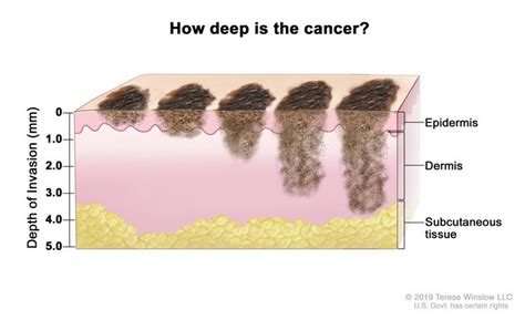 Melanoma Skin Cancer Stages