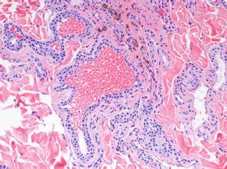 Histology of Vascular Malformations | Oncohema Key