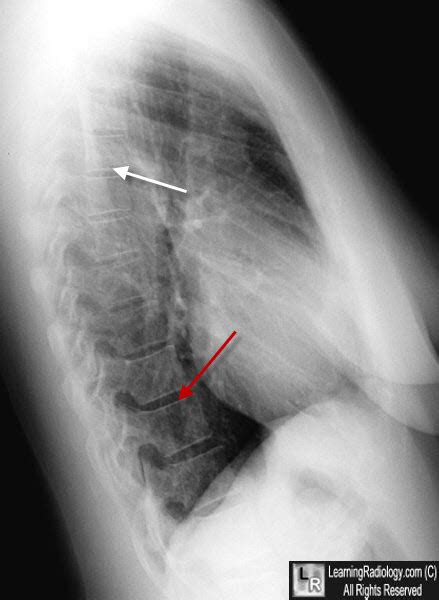 Learning Radiology - Spine Sign