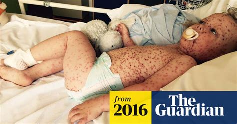 'Worst case of chickenpox' sparks call for rethink on vaccination ...