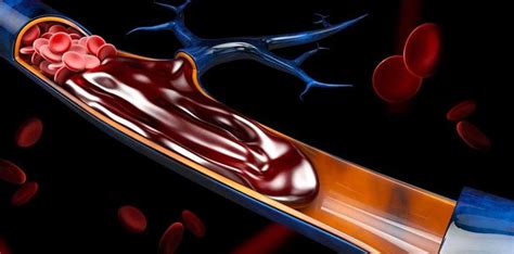 Blood Clot in Brain: Symptoms, Diagnosis & Treatment