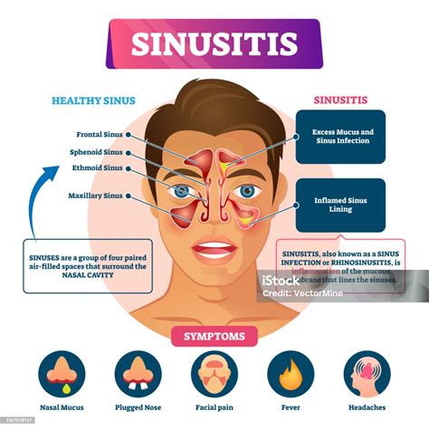 Vetores de Ilustração Do Vetor Da Sinusite Esquema Inflamatório ...