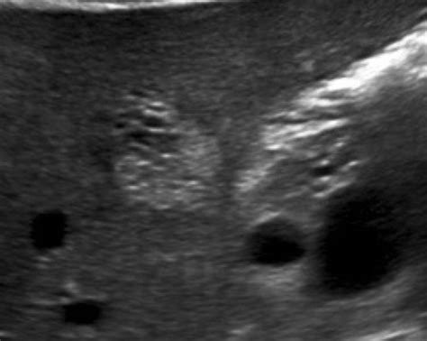 Liver Atlas: Diagnosis: Hemangioma