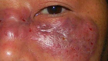 Mucormycosis - mold infection on the face | Mold-Help.org - The world's largest TOXIC MOLD website