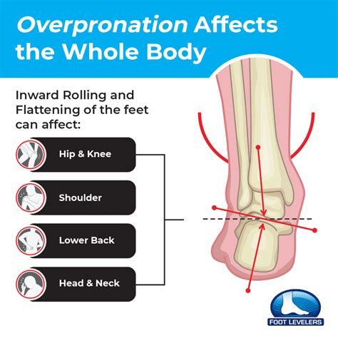 Overpronation - Feet Don’t Have to Hurt to be Hurting the Rest of Your Body | Foot Levelers