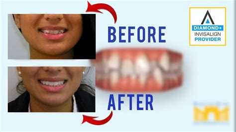 Invisalign Before And After Crowding