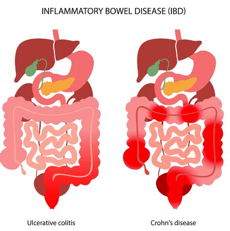 The Relationship between Mucus in Stool and Inflammatory Bowel Disease ...