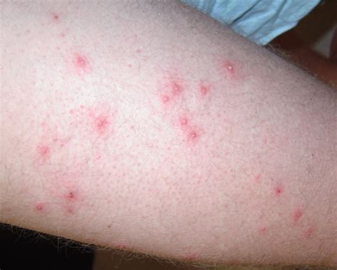 Folliculitis - Causes, Signs, Symptoms, How to Get Rid of Folliculitis