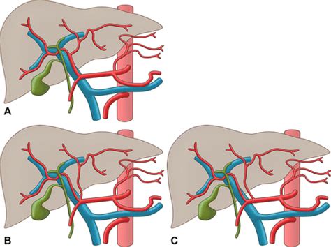 Anatomic Variations of the Hepatic Artery in 5625 Patients | Radiology: Cardiothoracic Imaging