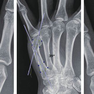 (PDF) Surgical Treatment of Metacarpal and Phalangeal Fracture with Rotational Malalignment