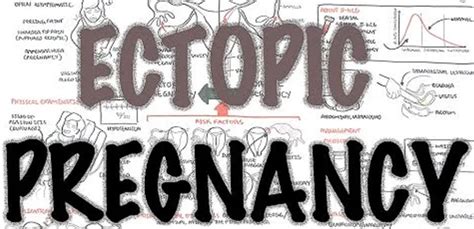 Causes of Ectopic Pregnancy: What to do! - ozochima