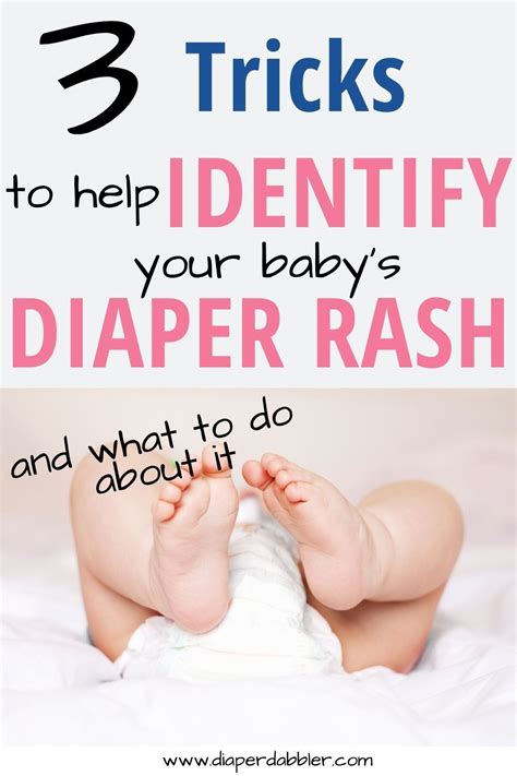 3 Tricks to Identify the Cause of your Baby's Diaper Rash | Baby diaper rash, Diaper rash ...