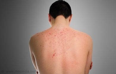 Flea Bites - Symptoms Diagnosis Treatment