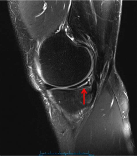 Longitudinal Tear of the Medial Meniscus | Meniscal Root Tear MRI ...