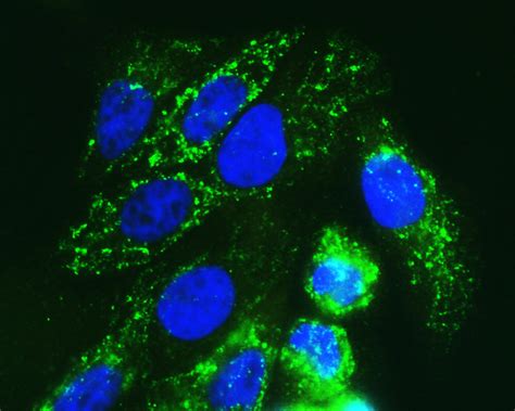 Cancer cell metabolism kills