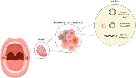 Frontiers | The Role of Human Papilloma Virus in Dictating Outcomes in Head and Neck Squamous ...