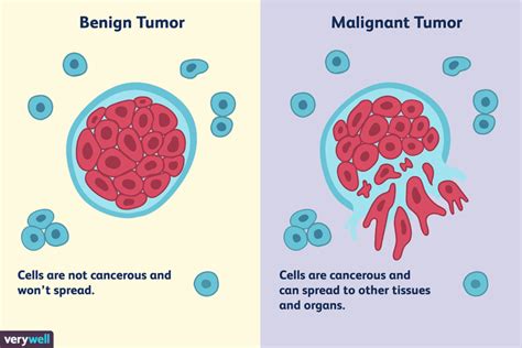 Differences Between a Malignant and Benign Tumor