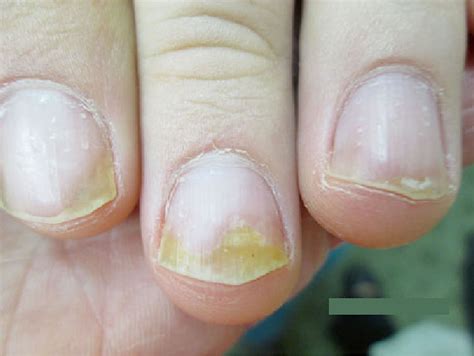 Nail psoriasis causes, symptoms, diagnosis, treatment & prognosis