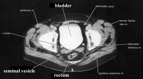 Colon and Rectal CT and PET Scans