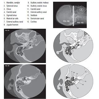 Temporal Bone - CT Scan - RadTechOnDuty