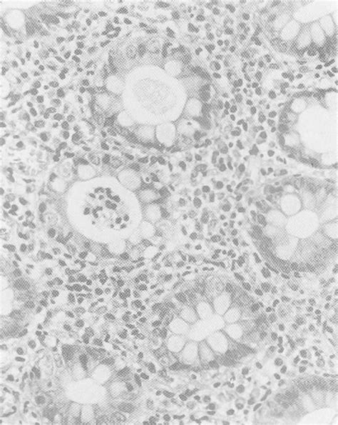 Figure 1 from Ulcerative colitis developing after amoebic dysentery in ...