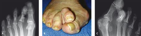 Correction of Crossover Toe Deformity | Musculoskeletal Key