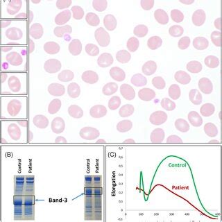 (A) Blood smear review showing ovalocytes, characterized by two... | Download Scientific Diagram