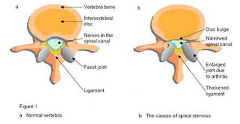 Stenosis: Bladder Neck Stenosis