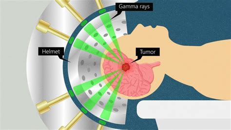 What are the side effects of stereotactic radiosurgery to the brain? | Medserg