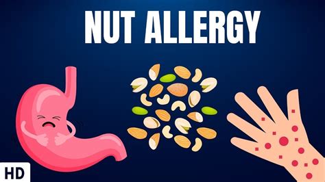 Tree Nut Allergy Symptoms In Child at Kenyatta Thomson blog