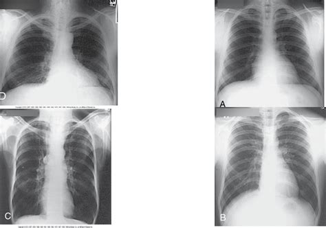 RTCA 121 - Chest Radiography - Body Habitus types on X-Ray Diagram ...