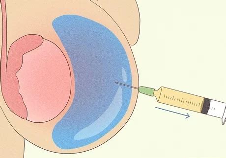 Hydrocele Cause And Treatment