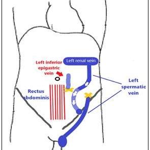 Superficial Epigastric Vein Anastomosis