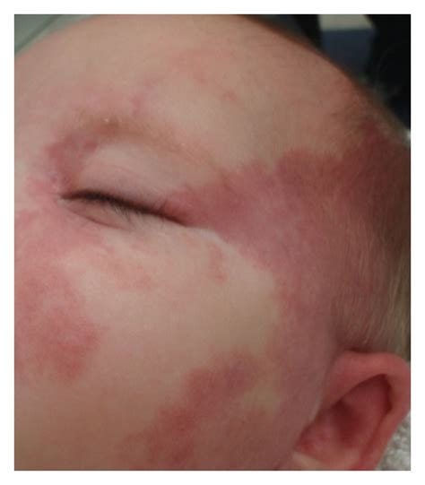 Capillary malformation (port wine stain) of the left face in infant ...