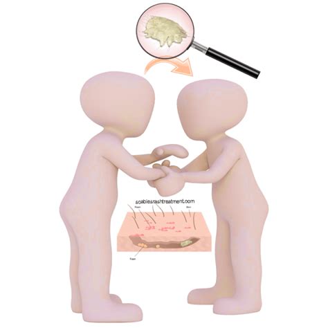 What Causes Scabies Archives