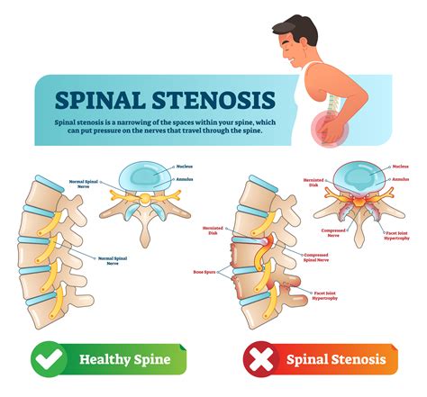 Spinal Stenosis Grades and Treatment Options | Premia Spine