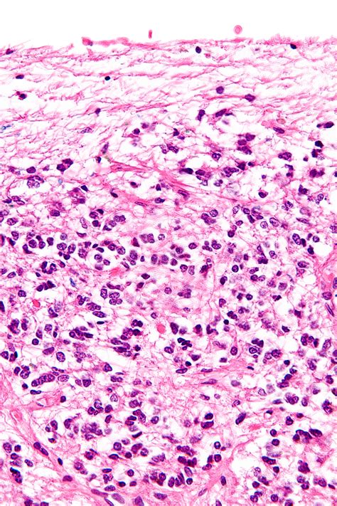 Calciet kristallen in de pijnappelklier