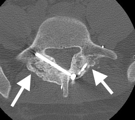 Surgical Repair of Pars Interarticularis Fractures | Colorado