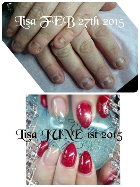 Before and after chronic nail biter Artistic Colour Gloss sculptured acrylic's | Artistic colour ...