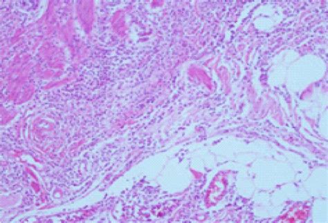 Figure 3 from Goblet cell carcinoid of the appendix and mixed ...