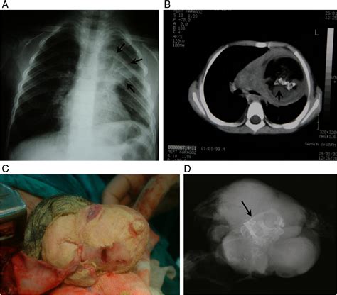 Two cases of fetus in fetu - Journal of Pediatric Surgery