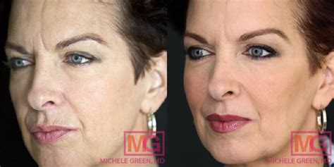 Facial Fillers, Types for Wrinkles, Dermal Filler - Dr. Michele Green M.D.