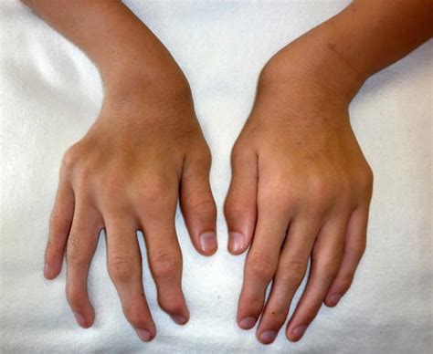 Morquio syndrome causes, symptoms, diagnosis, life expectancy & treatment