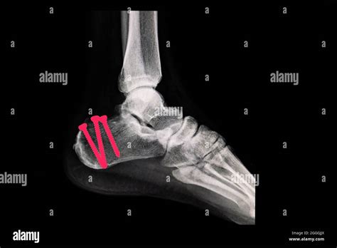 Compound Fracture X Ray