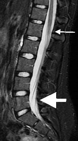 Diagnosis Of Cauda Equina Mri